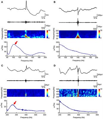 Determining the Quantitative Threshold of High-Frequency Oscillation Distribution to Delineate the Epileptogenic Zone by Automated Detection